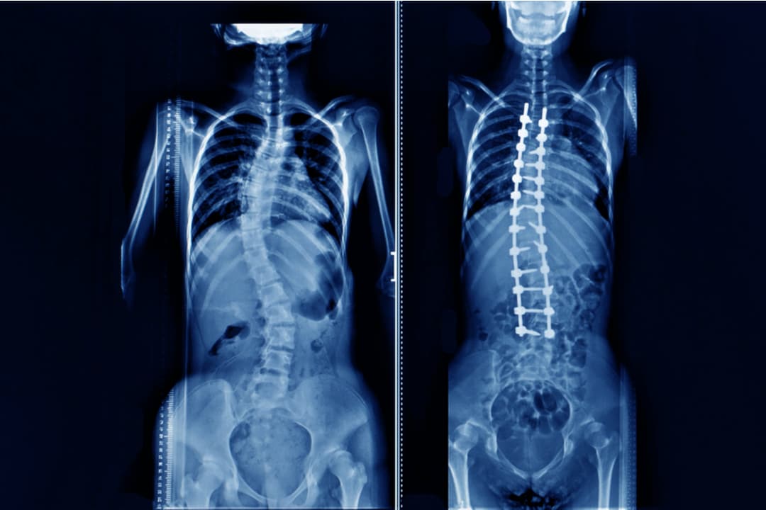 scoliosis-before-and-after.jpg